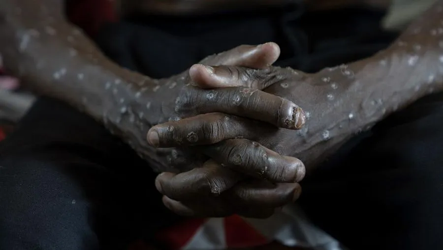 Mpox Naik di Thailand, Kenapa Bali Perlu Waspada?